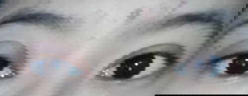 Kelopak mata bengkak