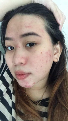 Wajah jerawatan dan kusam