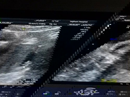 กังวลมากค่ะกลัวน้องโตช้า