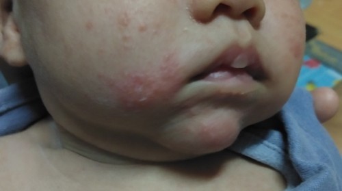 ผื่นแบบนี้คือผื่นอะไรหรอคะ