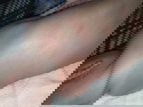 beruntusan pada baby 4 bulan