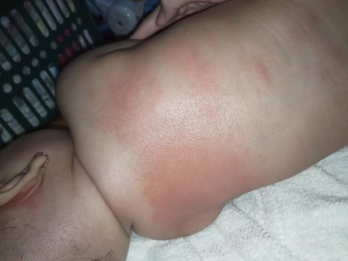 beruntusan pada baby 4 bulan