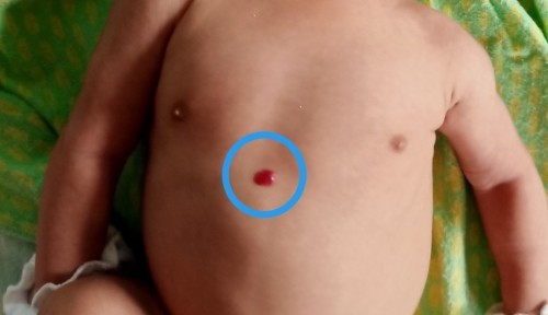 Red bump/birthmark yata?