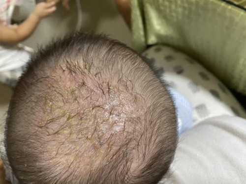 Baby cradle cap, is this normal?