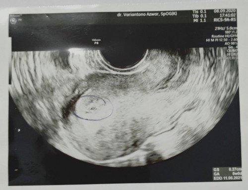 PCOS dan Hamil