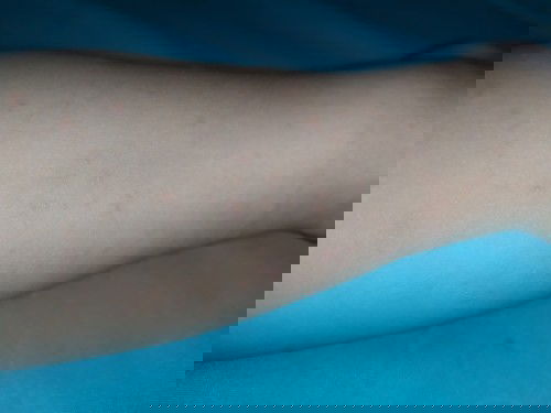 Bintik2 kecil daerah kaki tangan.