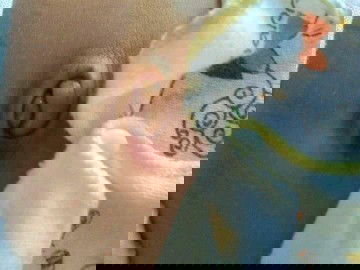 benjolan didekat pusar