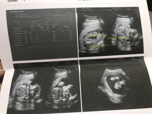 ทีมมกราคม แม่ดูเพศให้หน่อยคะ หมอบอกน้องเป็นหญิง แต่แม่ดูไม่ออก อยากซื้อของแล้วค่ะ ซาวตอน20w คะแม่ ขอบคุณคะ