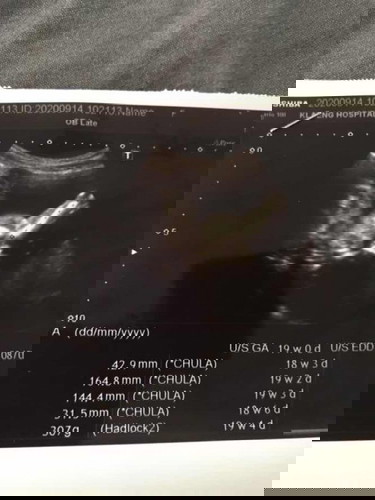 19w ช่วยดูหน่อยว่าลูกผู้หญิงผู้ชายค่ะถามหมอ หมอบอกว่ายังดูไม่ออก
