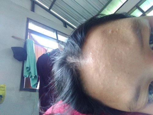 37+1วีค สิวเริ่มขึ้น