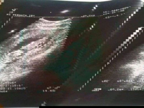 waktu 13 weeks skrng udh 34 weeks