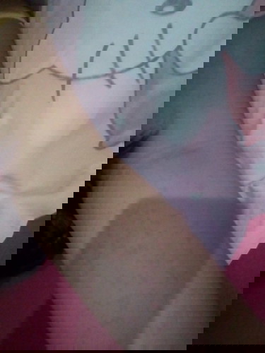 Rashes or tigdas ba? V