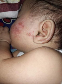 Help! sugat sa face ng baby koπ