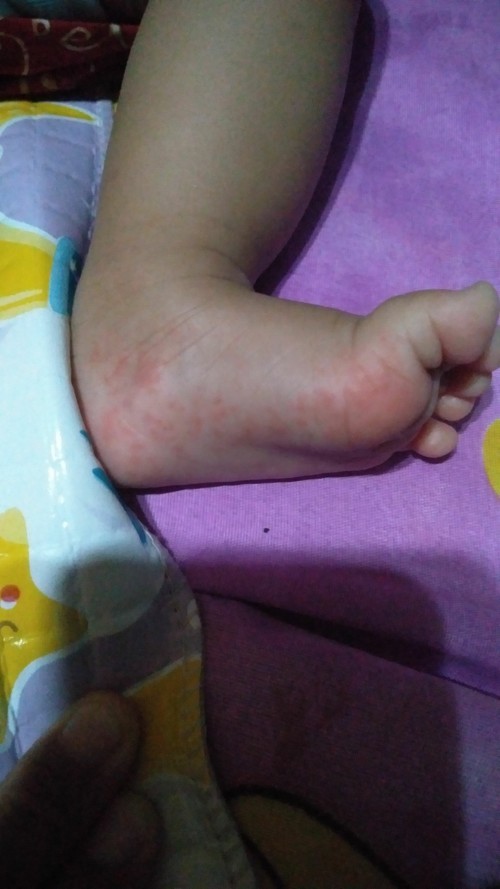 bintik tapak kaki tangan