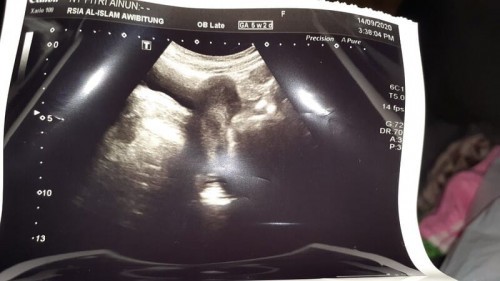 Kata Bidan dan Dokter Berbeda