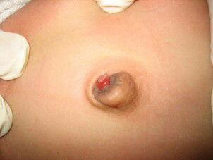 Bé sơ sinh bị chồi rốn ( hay còn gọi là u hạt rốn ) có nguy hiểm không và cách chữa cho bé như nào ?