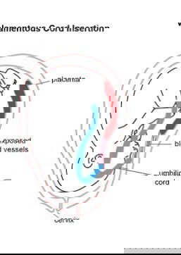 มีใครเป็น Velamentous cord insertion บ้างคะ ขอความรู้เพิ่มเติมหน่อยค่ะ