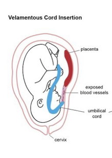 มีใครเป็น Velamentous cord insertion บ้างคะ ขอความรู้เพิ่มเติมหน่อยค่ะ