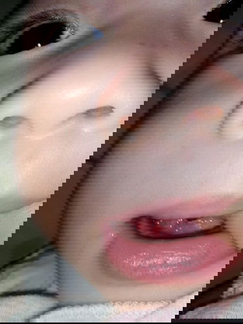 Anong gamot sa singaw?