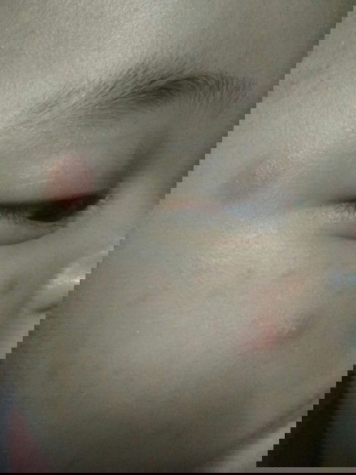 bekas gigitan nyamuk