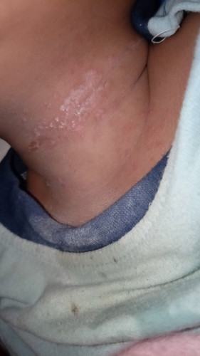 ลูกน้อยเป็นผื่น