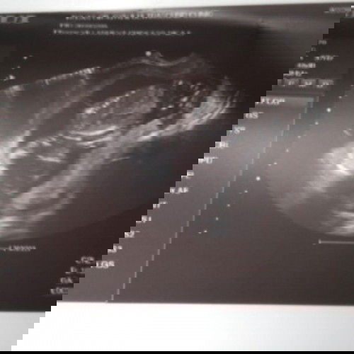 Transv ultrasound