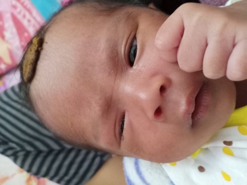 Belekan pada bayi
