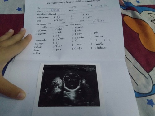 เรื่องของการกลับหัวของลูกค่ะกลับตอนกี่วีคถึงจะไม่เสี่ยงคลอดก่อนกำหนด