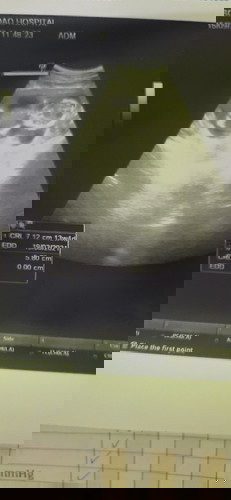 อายุครรภ์ไม่ตรงกับเครื่องอัลตร้าซาวด์