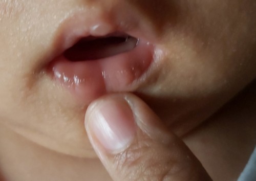 Bakit po nagkakadark sa lips?