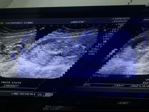 ไปอัลตร้าซาวด์ที่คลินิก กี่วีคค่ะถึงจะรู้เพศ