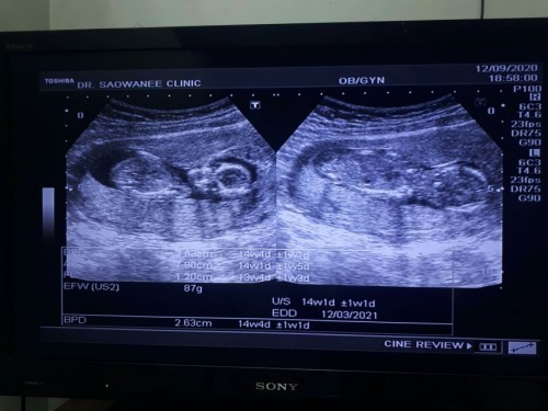 ไปอัลตร้าซาวด์ที่คลินิก กี่วีคค่ะถึงจะรู้เพศ