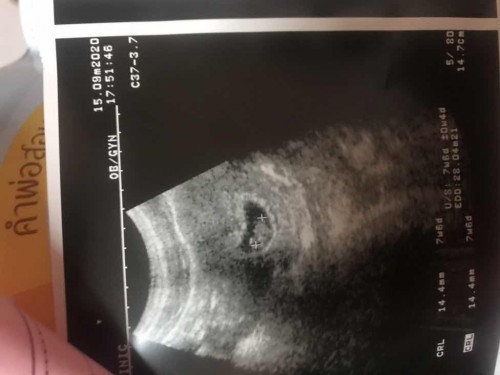 ท้องแรก7วีค6วัน