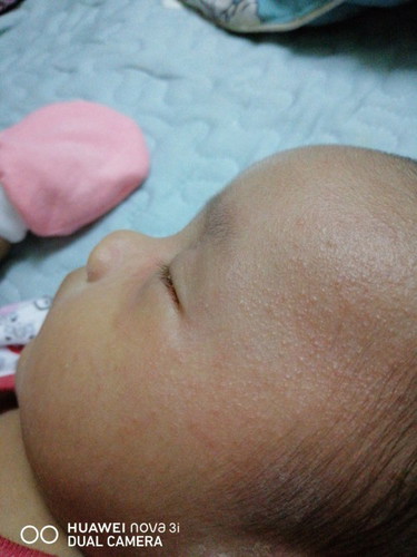 Baby Alami Ruam Di Bhgn Muka Dan Leher.