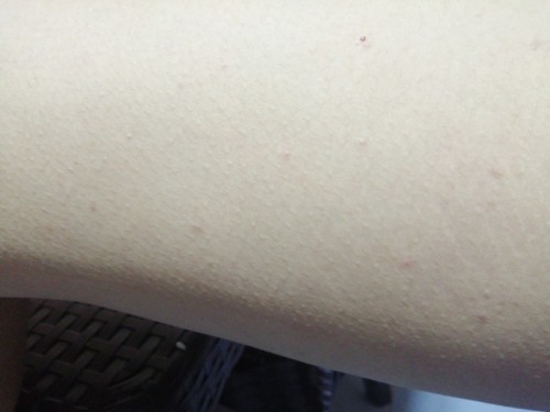 Scabies or hindi?