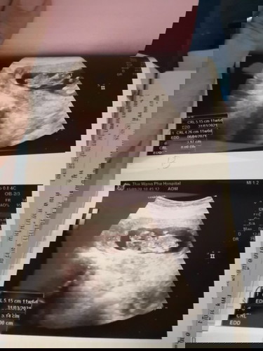 ขอแชร์ความรู้ประสบการณ์คุณแม่ท้องแฝดหน่อยคะ ดูแลตัวเองยังไงบ้าง บ้านนี้ท้อง3 ได้แฝดเฉยเลย😄