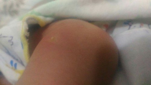Masalah kulit bayi umur 6hr