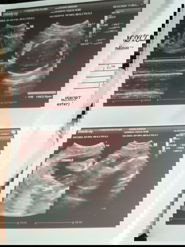 Ultrasound