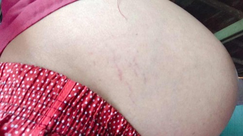 ท้องแตกลายในเดือนสุดท้าย