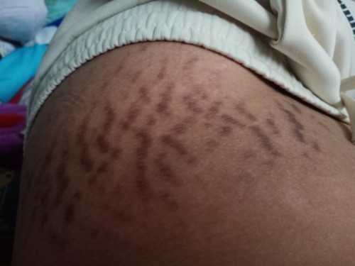 ใช้อะไรเเล้วรอยเเตกหายบ้าง