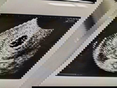 ท้องแฝดหรือเปล่า??