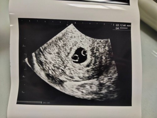 ท้องแฝดหรือเปล่า??