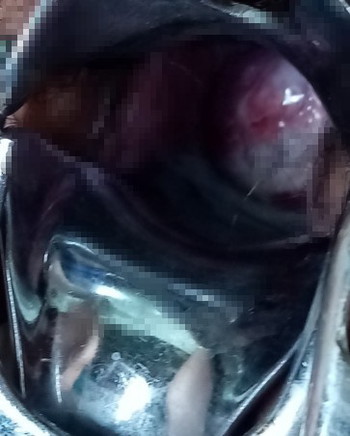 MAY GASGAS ANG CERVIX