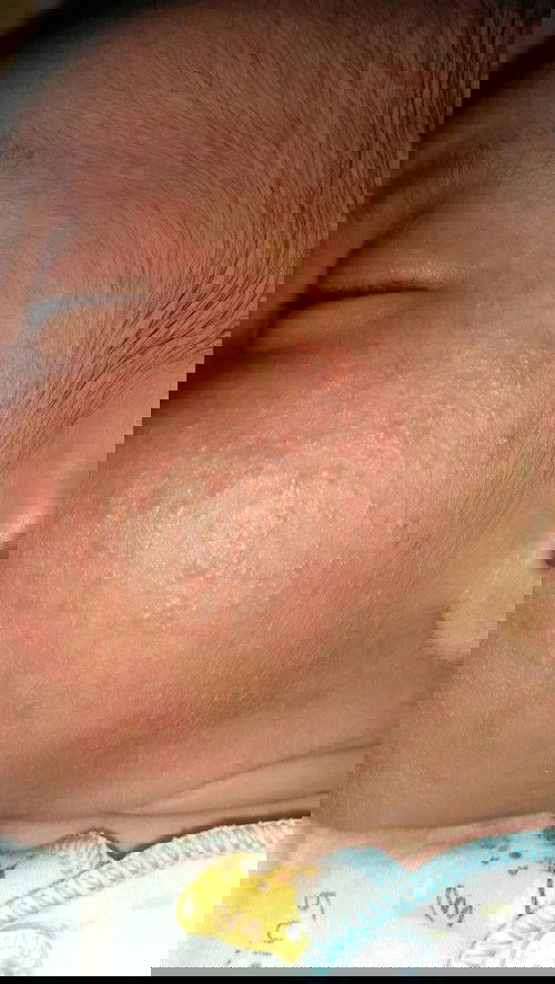 ruam pipi bayi umur 21 hari