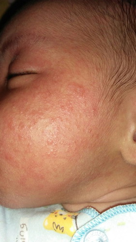 ruam pipi bayi umur 21 hari