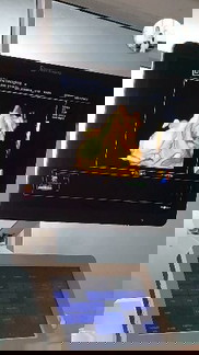 27w4d s.âm thai nhi bị giãn hố sau 18mm liệu có sao k ạ e lo quá 🙁