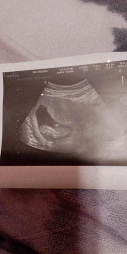 Is light bleeding normal in first trimester?