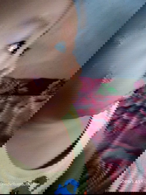 'ringworm atau impetigo