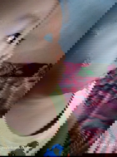 'ringworm atau impetigo