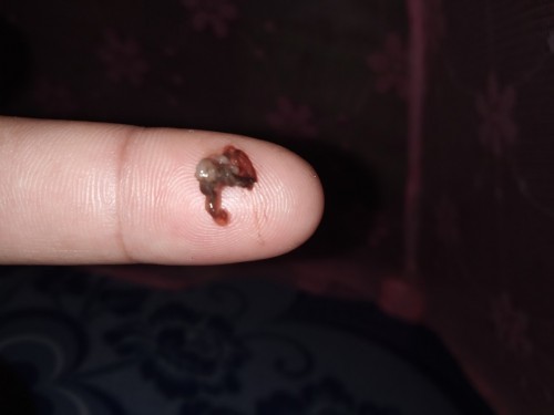 ขออนุญาตนะคะ39+4แล้วมีแบบนี้ออกมาแต่ไม่เยอะไกล้คลอดรึยังค่ะ